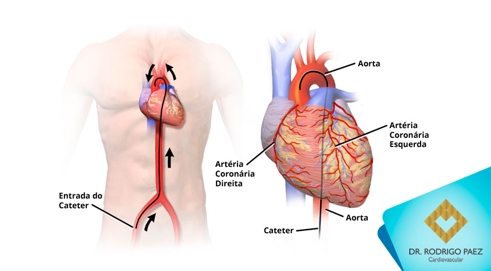 O que é o Cateterismo Cardíaco?