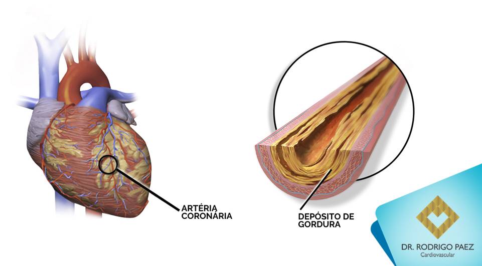 Doença Arterial Coronariana - uma visão geral da doença.