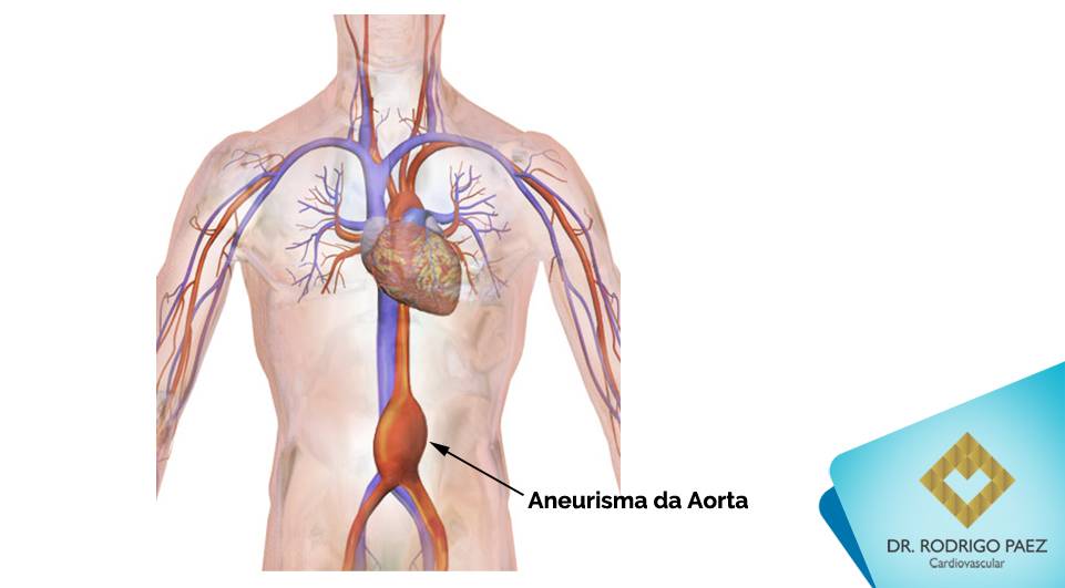 Você sabe o que é Aneurisma da Aorta Abdominal?