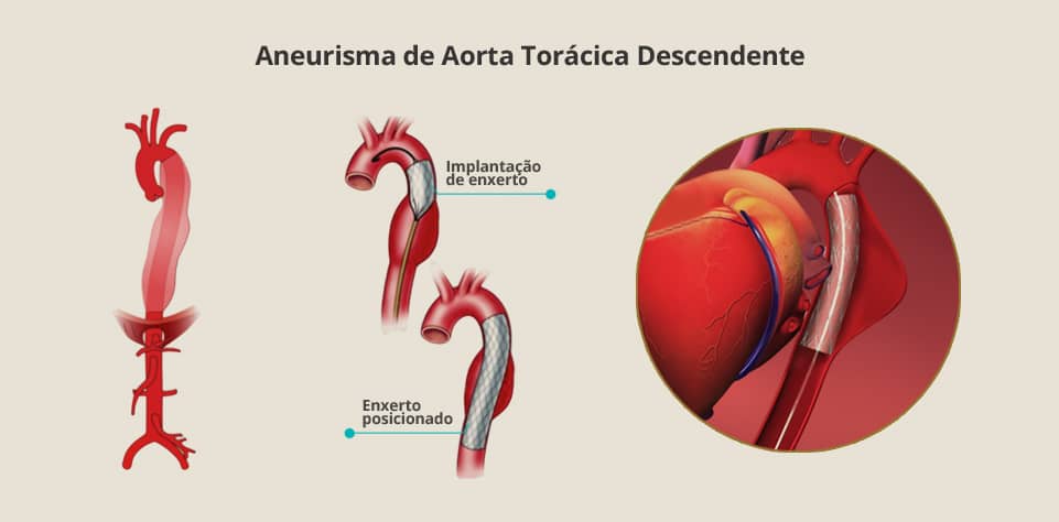 Aneurisma de Aorta Torácica Descendente