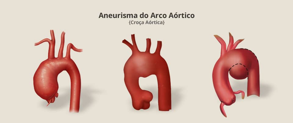 Aneurisma do Arco Aórtico (Croça Aórtica)