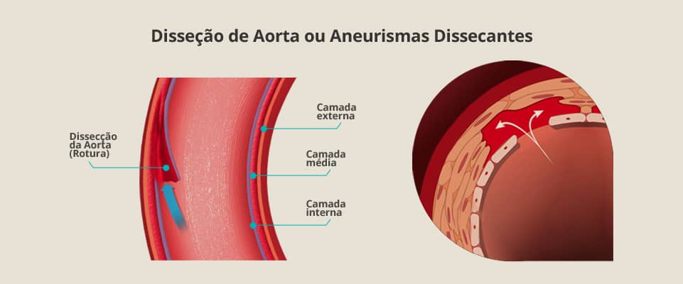 Aneurisma de Aorta Abdominal
