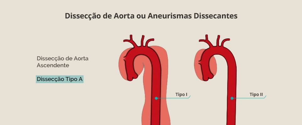 Dissecção de Aorta ou Aneurismas Dissecantes (Tipo A)
