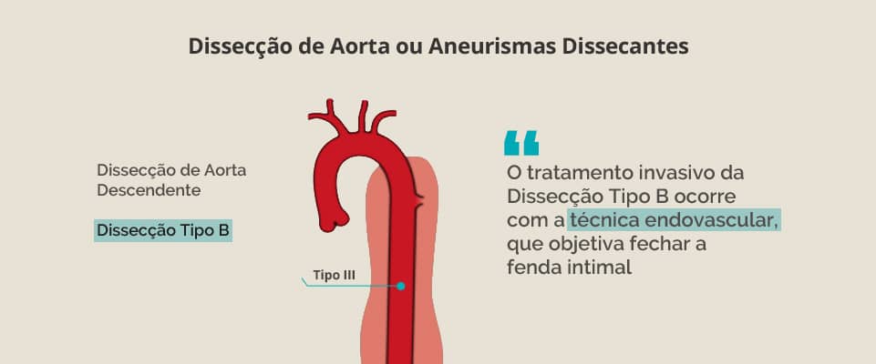 Dissecção de Aorta ou Aneurismas Dissecantes (Tipo B)