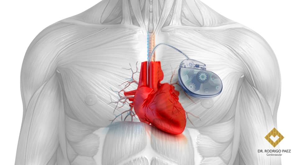 Um marcapasso "biônico" reverte a insuficiência cardíaca.